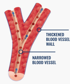 blood vessel with PAH