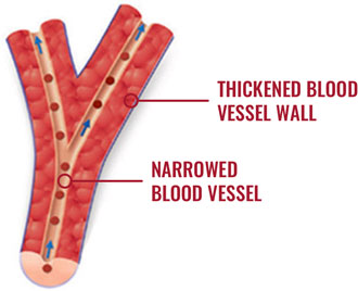 blood vessel with PAH